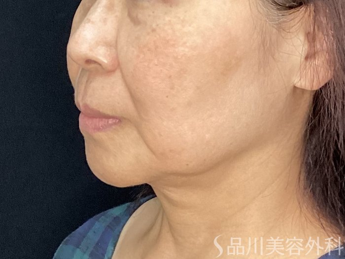 症例NO.71984のBEFORE写真