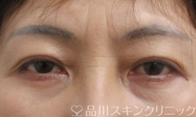 症例NO.69443のAFTER写真
