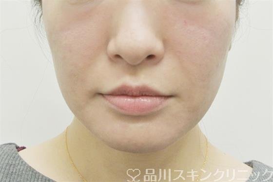 症例NO.37826のAFTER写真