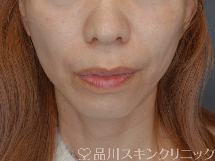 症例NO.72759のAFTER写真