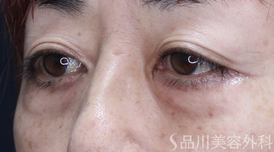 症例NO.71148のBEFORE写真