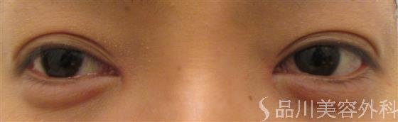 症例NO.20340のAFTER写真