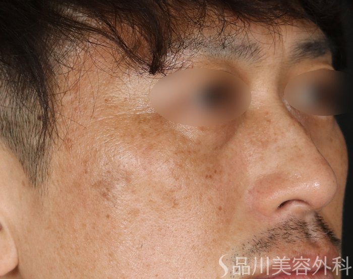 症例NO.73942のAFTER写真