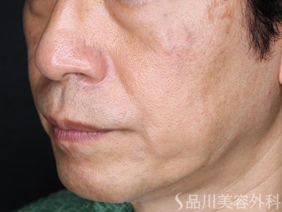 症例NO.74292のAFTER写真