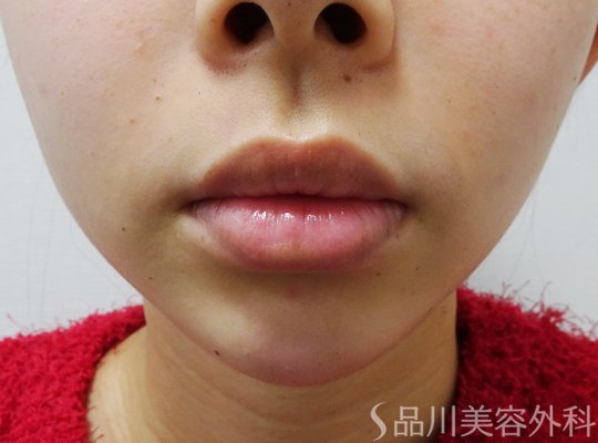 症例NO.73361のAFTER写真