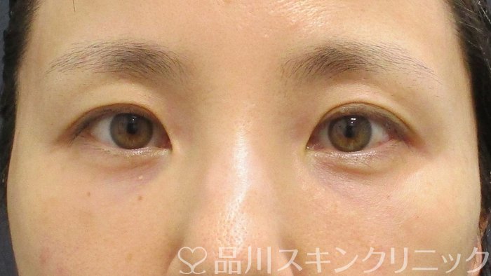 症例NO.65317のAFTER写真