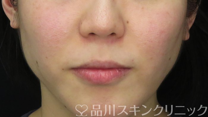 症例NO.70774のBEFORE写真