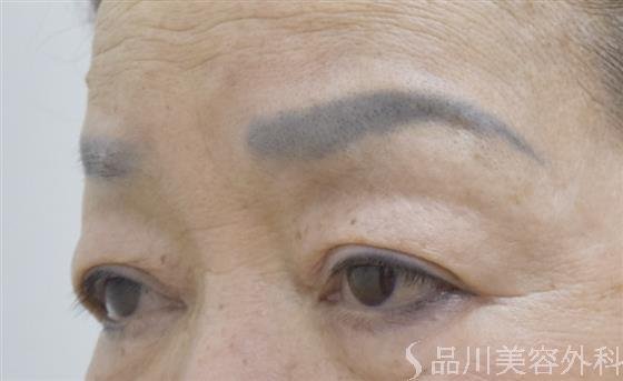 症例NO.54369のBEFORE写真