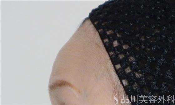 症例NO.51172のAFTER写真