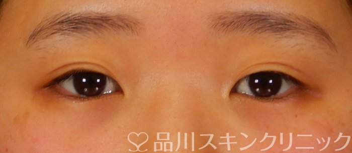 症例NO.63772のBEFORE写真