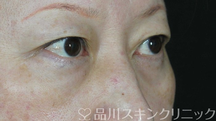 症例NO.72234のBEFORE写真