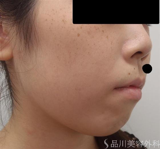 症例NO.6254のBEFORE写真