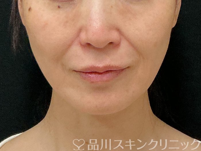 症例NO.74299のBEFORE写真