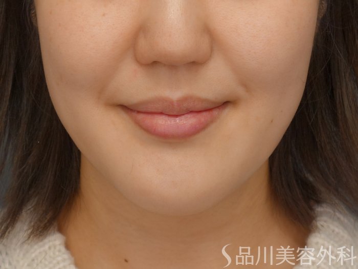 症例NO.69399のBEFORE写真
