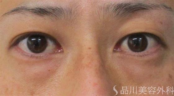 症例NO.53192のBEFORE写真