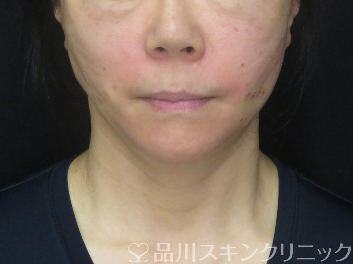 症例NO.69371のAFTER写真