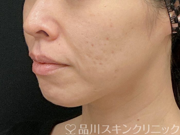 症例NO.74915のBEFORE写真