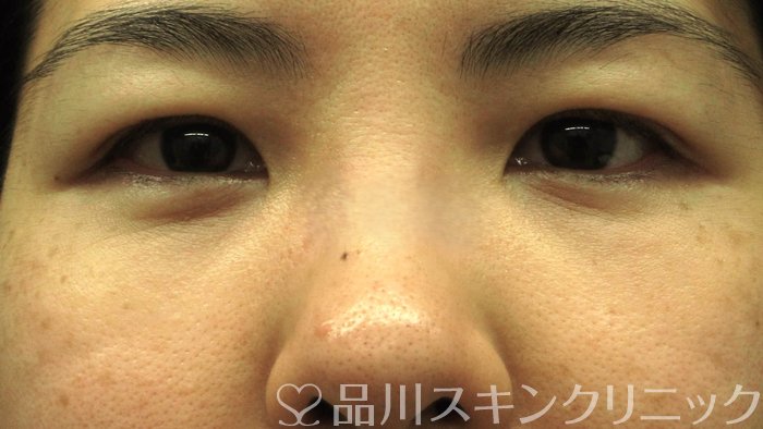 症例NO.69531のAFTER写真
