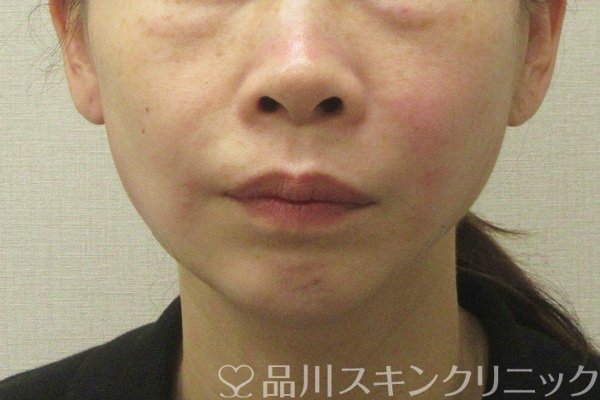 症例NO.74830のAFTER写真