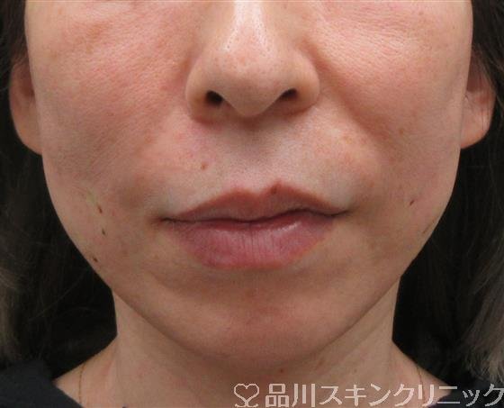 症例NO.54275のAFTER写真