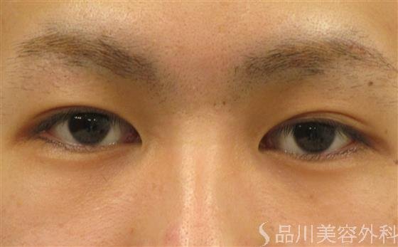 症例NO.56103のBEFORE写真