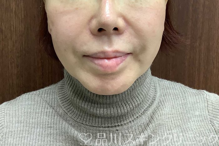 症例NO.71291のBEFORE写真