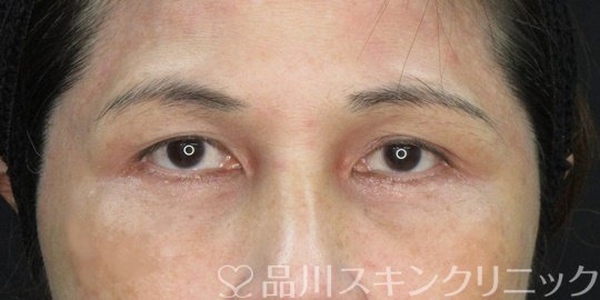 症例NO.75327のAFTER写真
