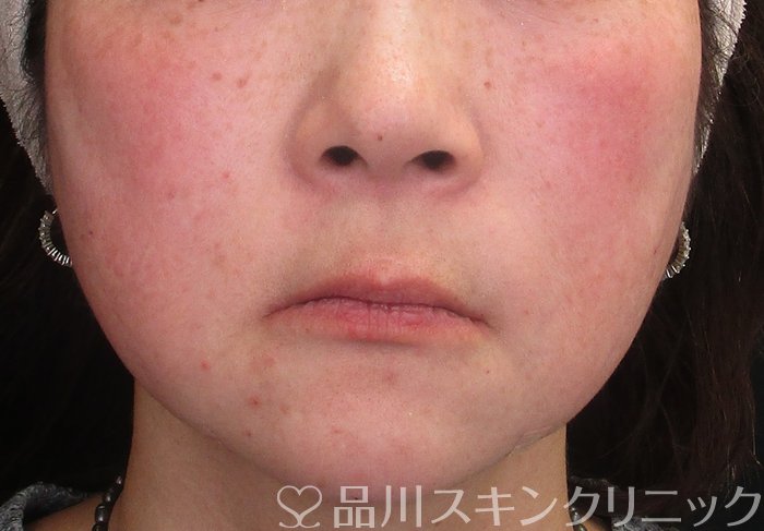 症例NO.72929のAFTER写真