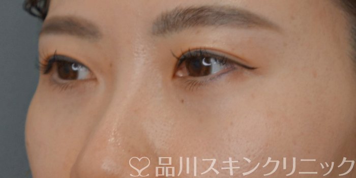 症例NO.73388のAFTER写真