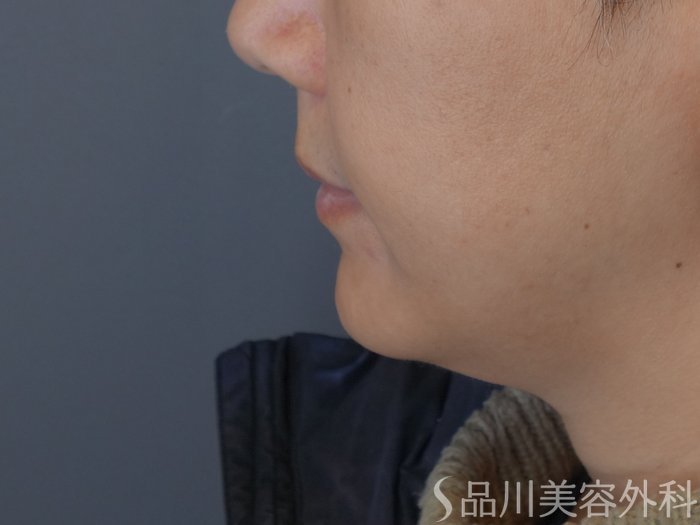 症例NO.72948のAFTER写真