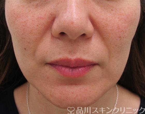 症例NO.34060のBEFORE写真