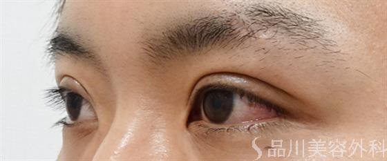 症例NO.50930のAFTER写真