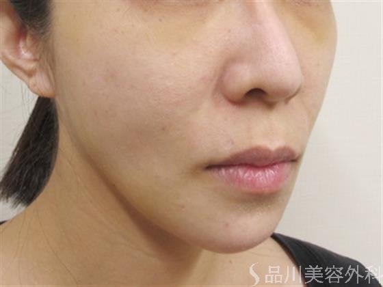 症例NO.41474のAFTER写真