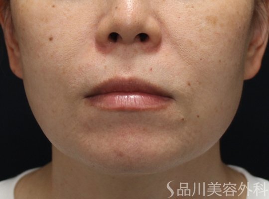 症例NO.74960のBEFORE写真