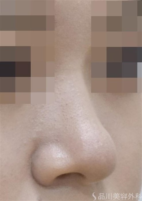 症例NO.52914のAFTER写真