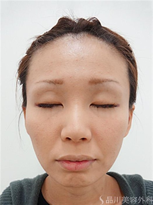 症例NO.26656のBEFORE写真