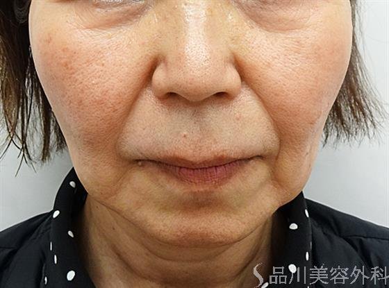 症例NO.47769のBEFORE写真