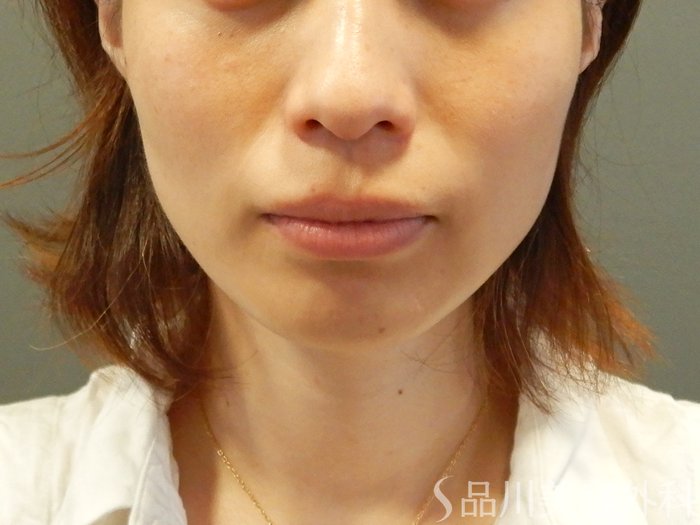 症例NO.65709のBEFORE写真