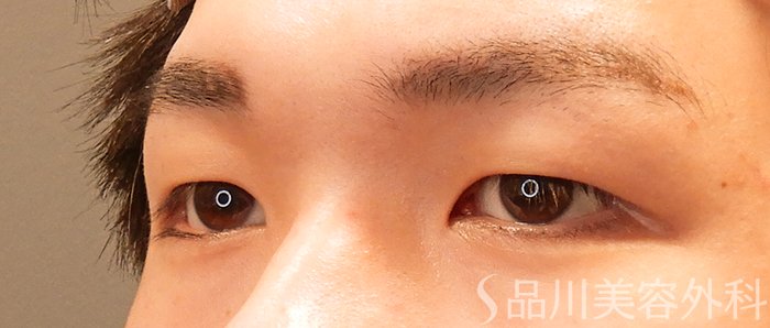 症例NO.70500のBEFORE写真