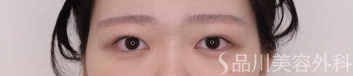 症例NO.69372のAFTER写真