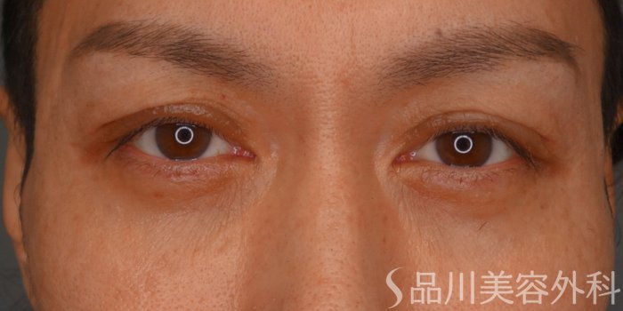 症例NO.74412のAFTER写真
