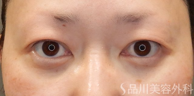 症例NO.74246のAFTER写真