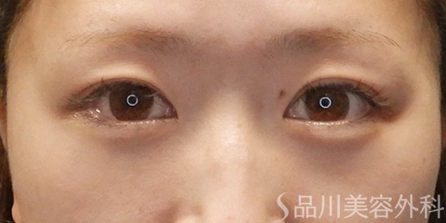 症例NO.74060のAFTER写真