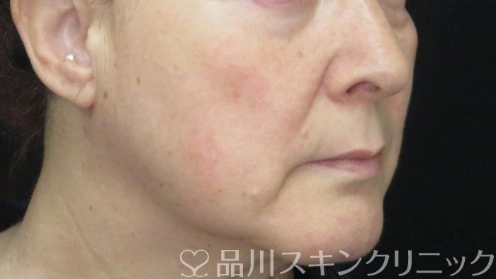 症例NO.71051のBEFORE写真