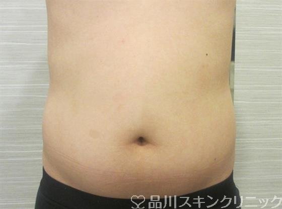 症例NO.33132のBEFORE写真