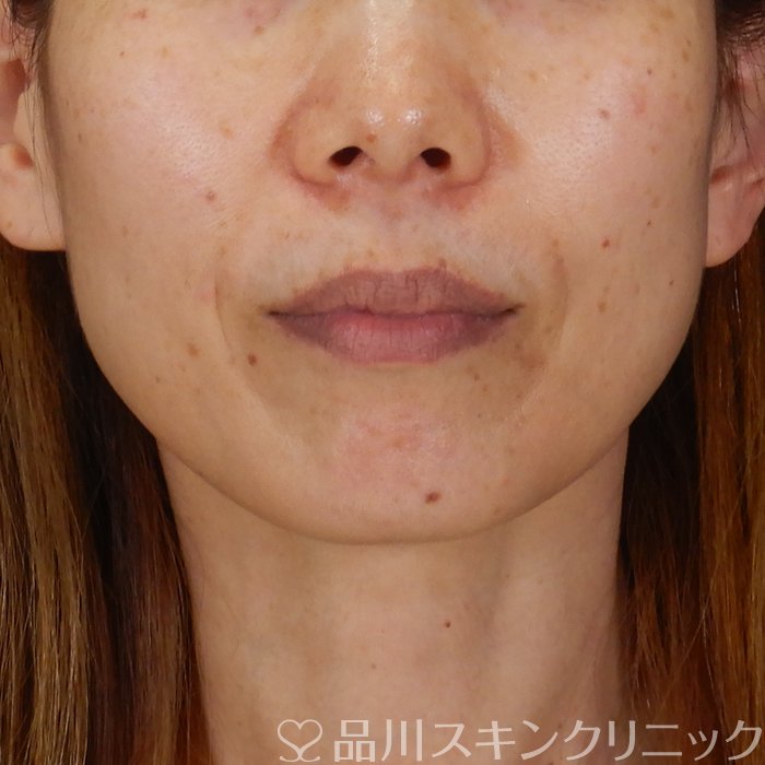 症例NO.63104のBEFORE写真