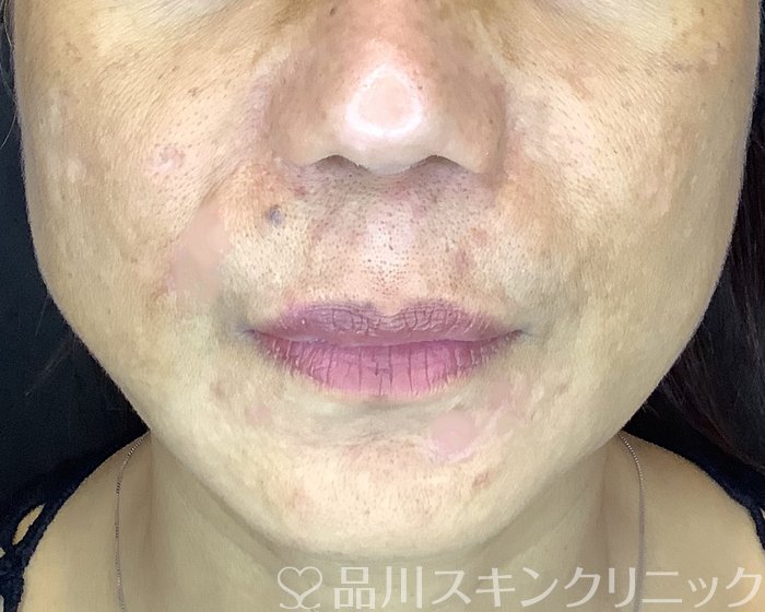 症例NO.69951のAFTER写真