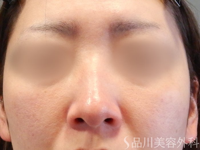 症例NO.65543のAFTER写真