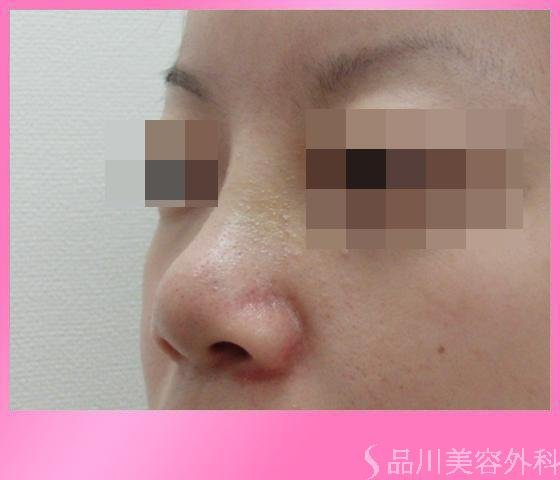症例NO.3003のAFTER写真