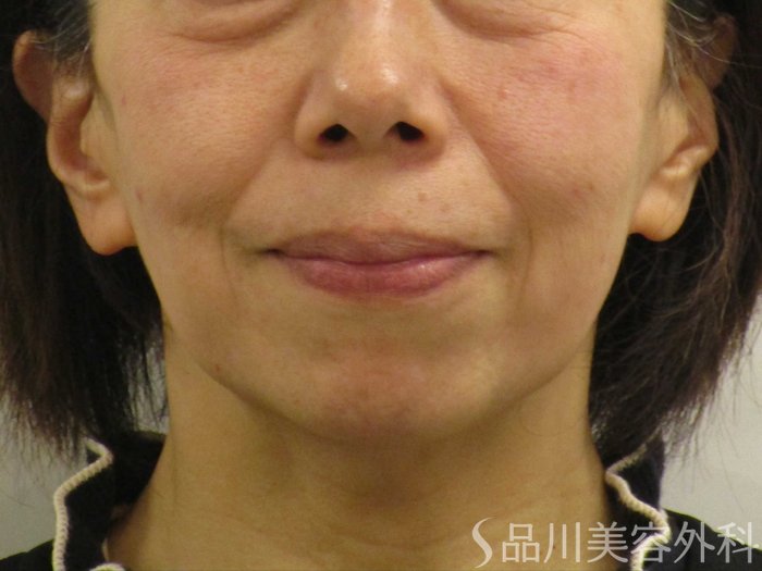 症例NO.74911のBEFORE写真